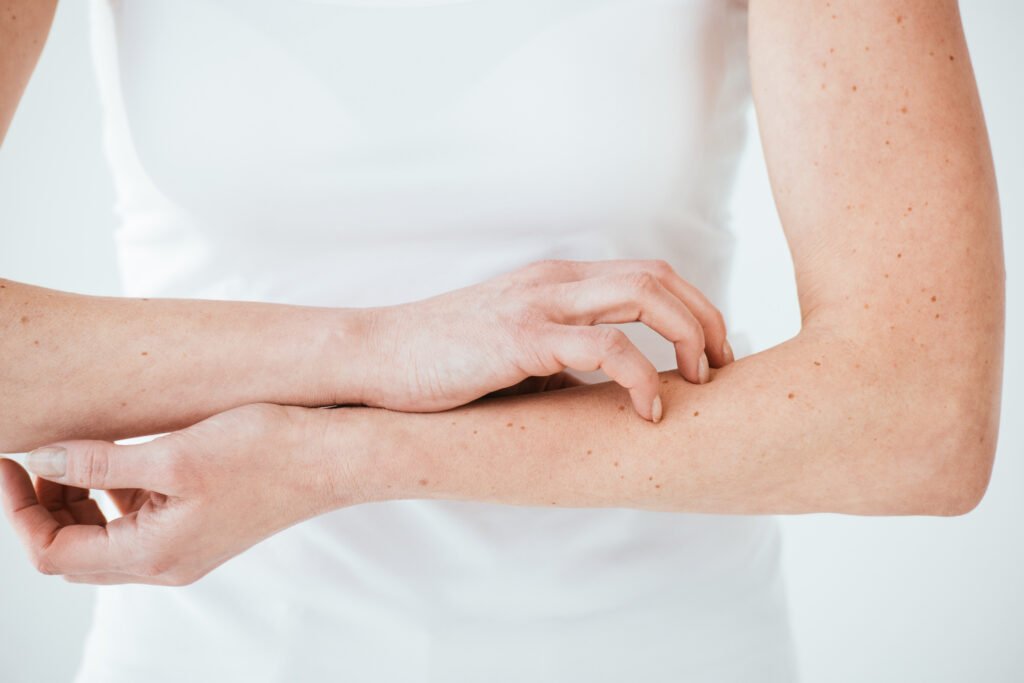 focused view of diabetic coused allergic woman scratching hands on white