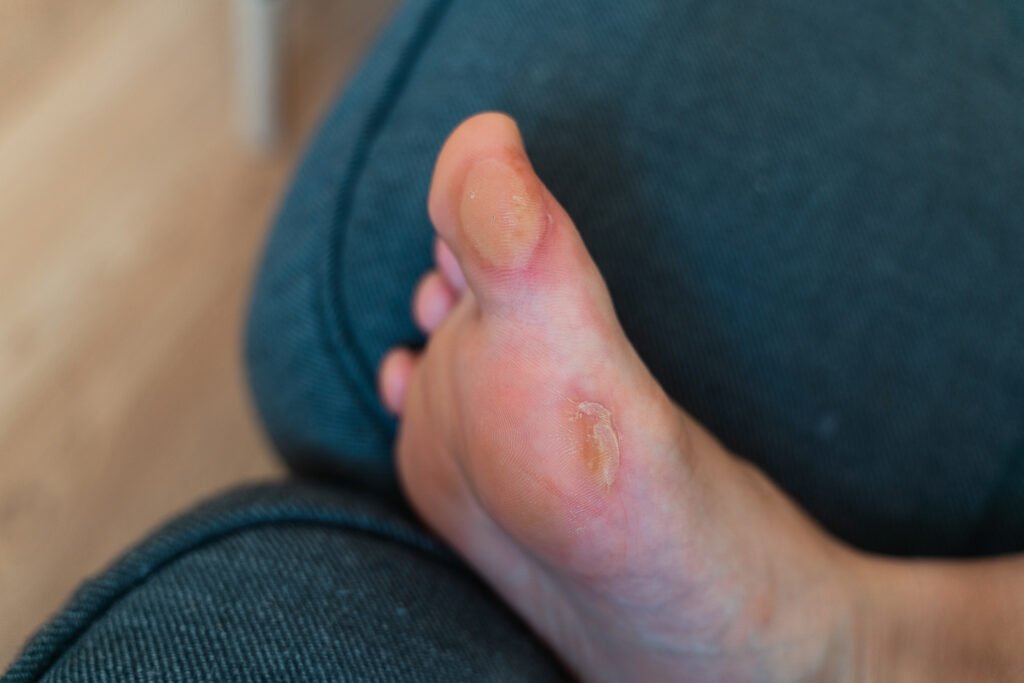 Close-up of a soft callus on a foot of a woman,corn on the leg. blister on the feet .