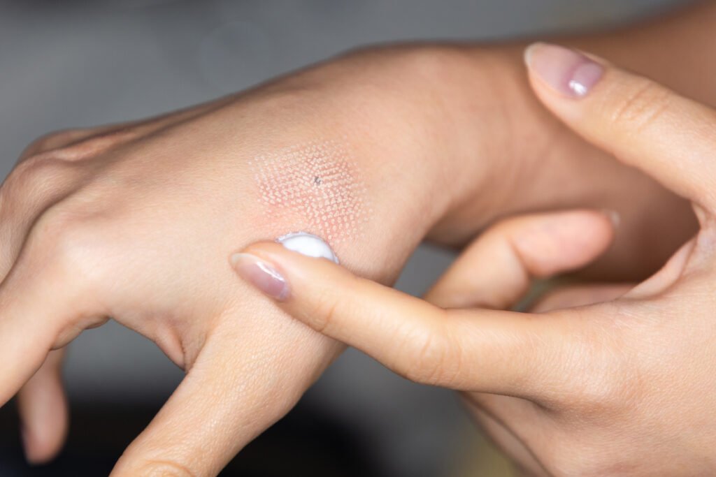 women applying medicated cream on fresh marks .