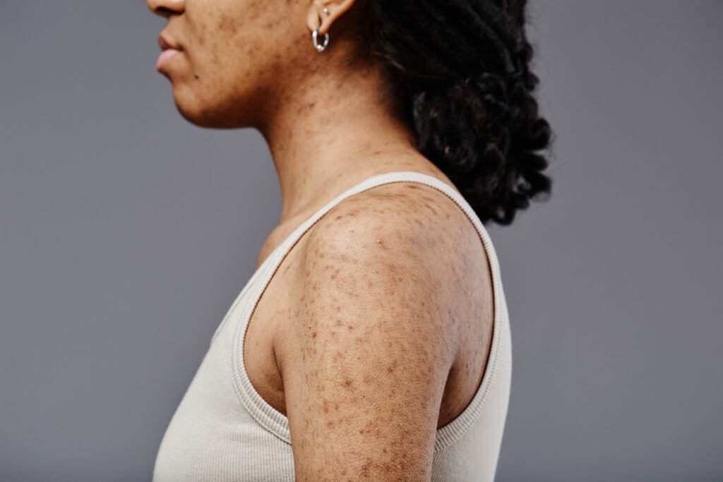 Closeup side view of black young woman with real skin texture with symtoms of hpv disease on shoulders and arms.