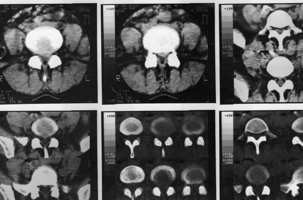 x-ray film of the breast cancer computed tomography